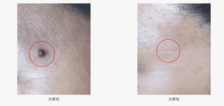 平坦で小さいほくろ（〜4mm）の治療法と料金相場、症例写真