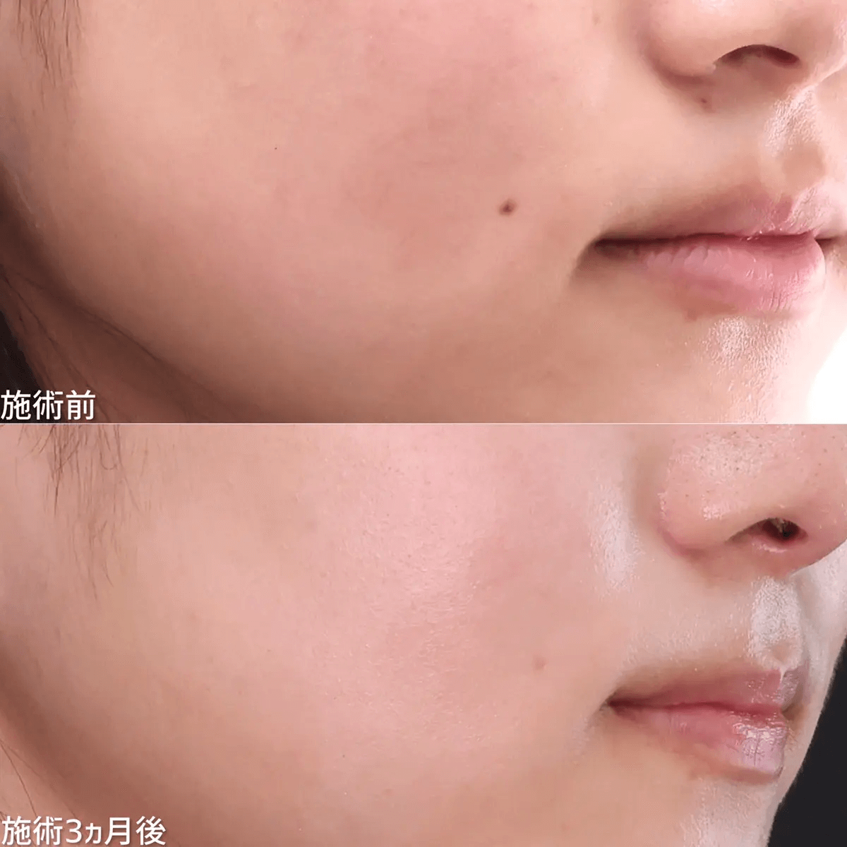 銀座TAクリニック-ホクロ症例写真