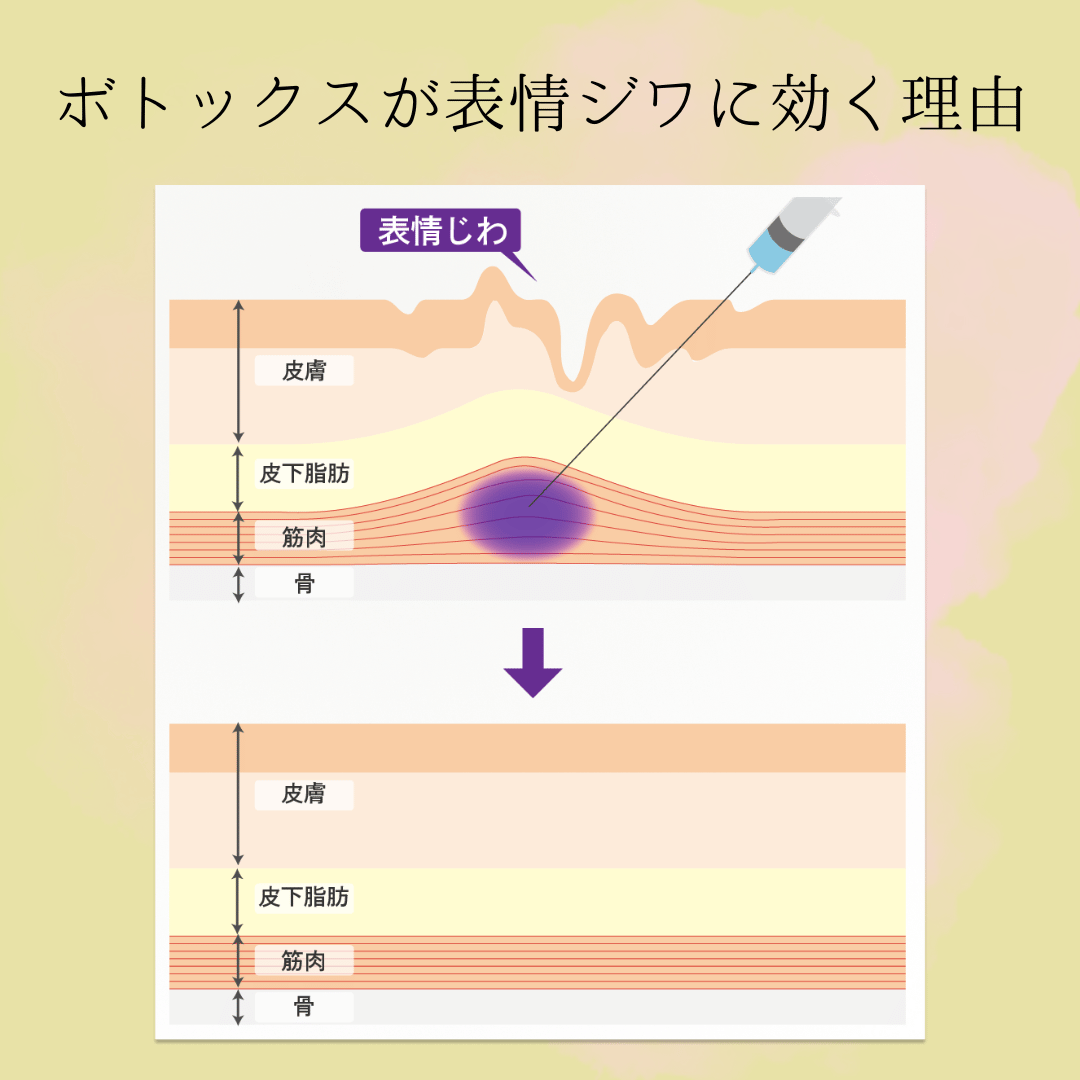 ボトックスが表情ジワに聞く理由