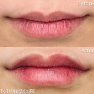 TCB東京中央美容外科-唇ヒアルロン酸症例写真