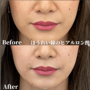 TCB東京中央美容外科症例-ほうれい線