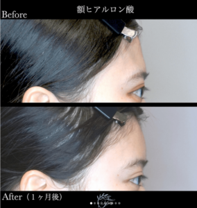 フェイス美容外科-額ヒアルロン酸症例写真