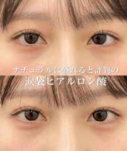 リベルクリニック症例-波袋