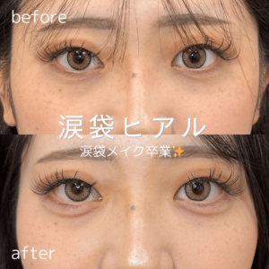 ルラ美容クリニック-涙袋ヒアルロン酸症例写真
