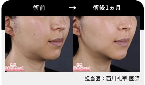 湘南美容クリニック医療ハイフ症例写真