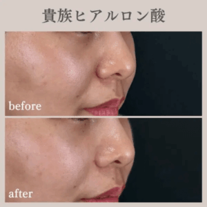 CLINIC W-貴族ヒアルロン酸症例写真