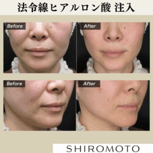 城本クリニック高崎院-ヒアルロン酸ほうれい線症例写真