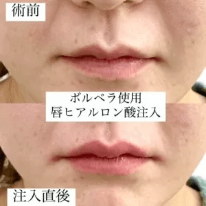 高崎美容クリニック-ヒアルロン酸くちびる症例写真