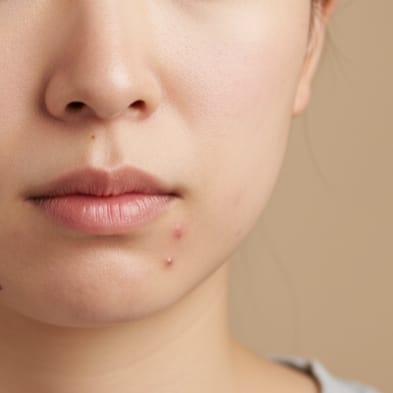 繰り返すニキビ：同じ場所に何度もニキビができてしまう肌質そのものの悩み。イメージ写真