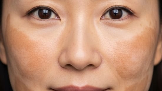 肝斑の写真