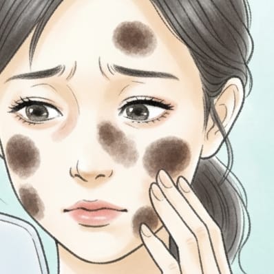 老人性色素斑-（濃いシミ）に悩む女性イメージイラスト