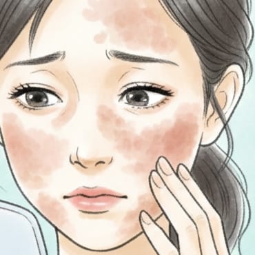 肝斑・シミに悩む女性イメージイラスト