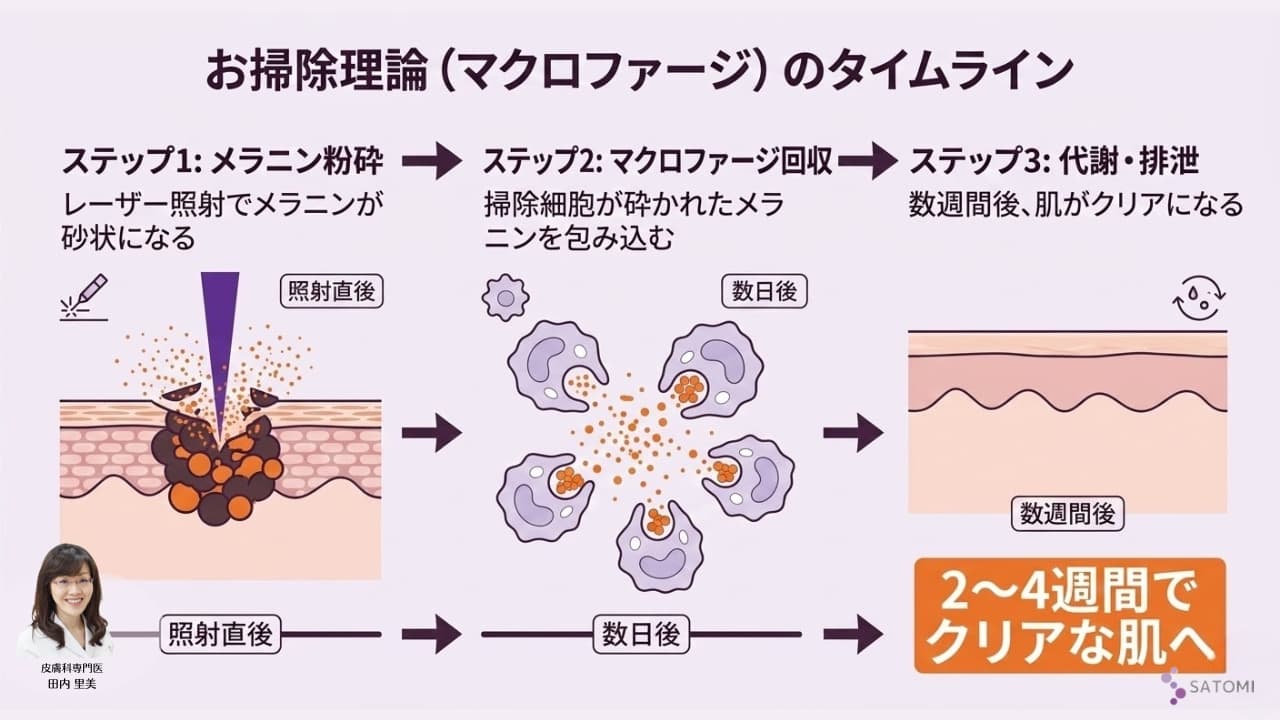 ピコトーニング照射後、マクロファージ（掃除細胞）が粉砕されたメラニンを回収・排泄し、2〜4週間かけて肌がクリアになるプロセスのタイムライン図解