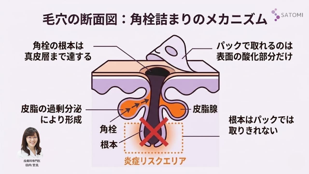 専門医が解説するいちご鼻(毛穴汚れ)のメカニズム。セルフケアでは届かない毛穴の奥深くに詰まった角栓と皮膚組織の構造図